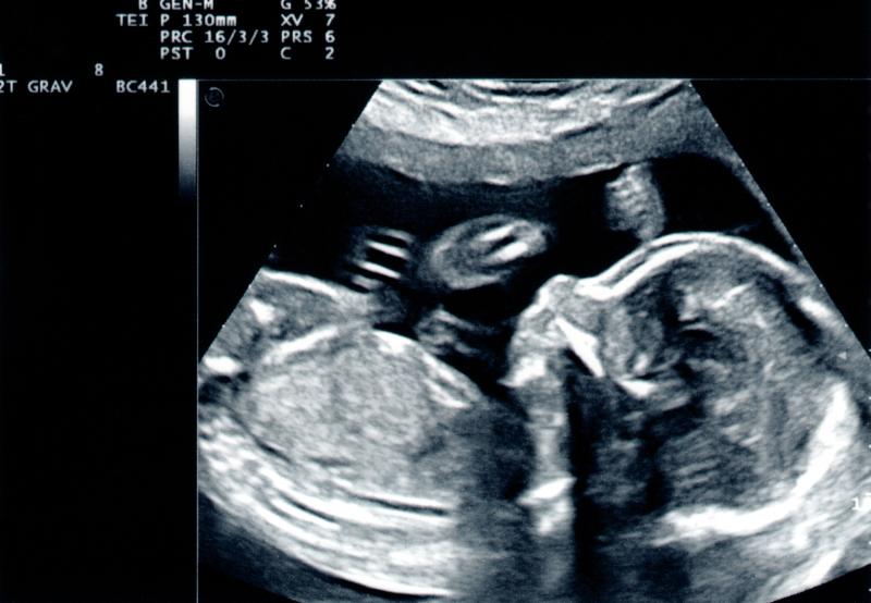 USG w ciąży - najważniejsze informacje